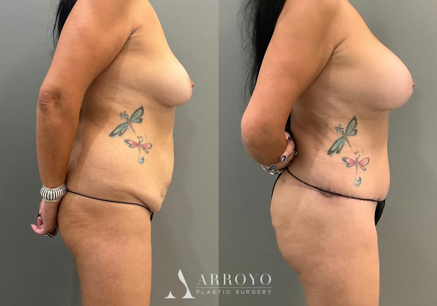 Tummy Tuck Before & After Gallery - Patient 336270 - Image 3