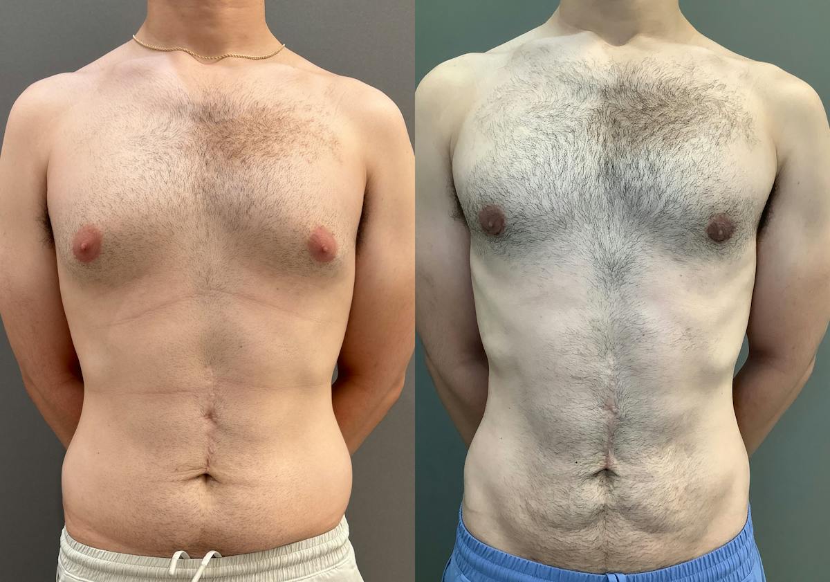 Gynecomastia Before & After Gallery - Patient 331523 - Image 1