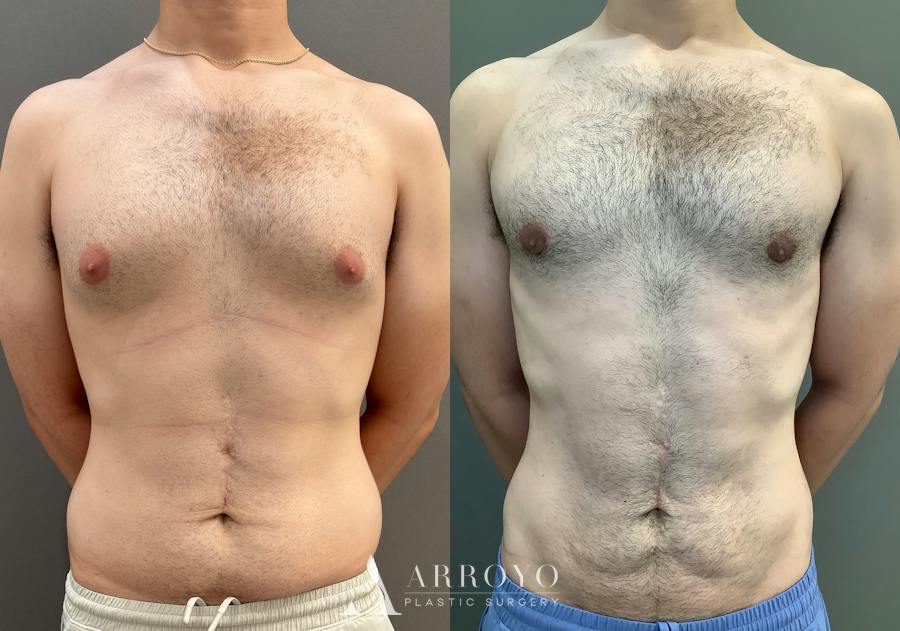 Gynecomastia Before & After Gallery - Patient 331523 - Image 1