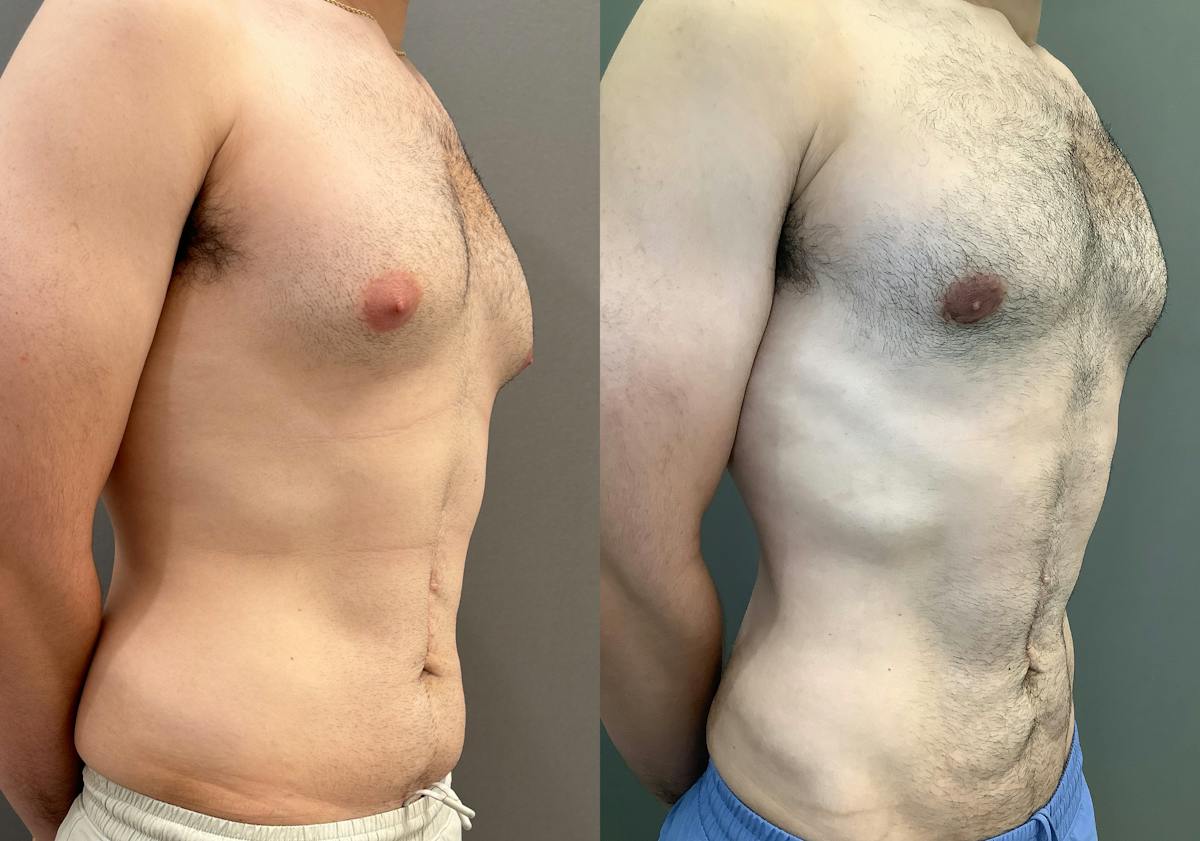 Gynecomastia Before & After Gallery - Patient 331523 - Image 2