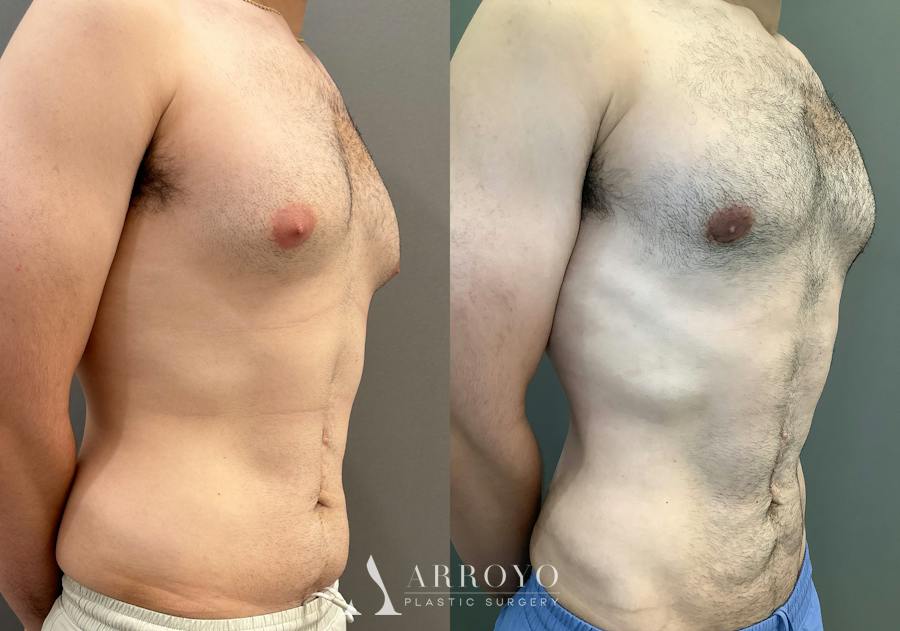 Gynecomastia Before & After Gallery - Patient 331523 - Image 2