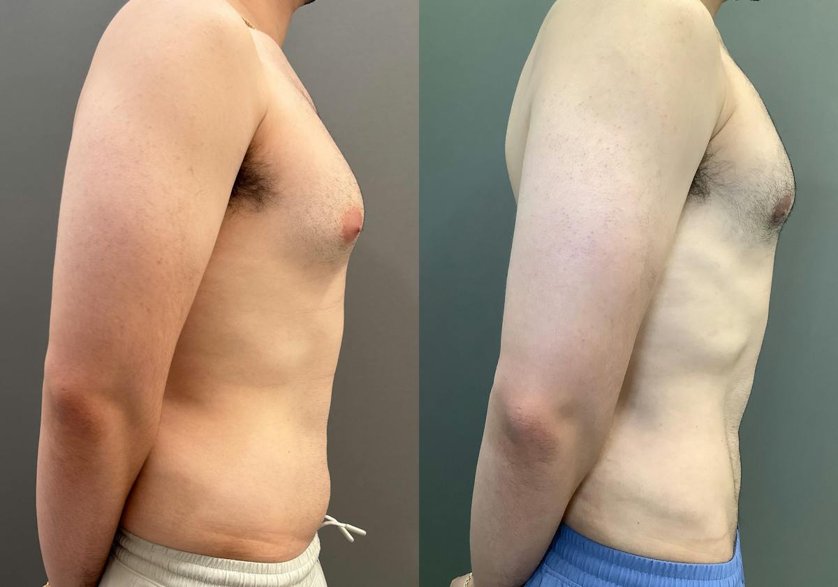 Gynecomastia Before & After Gallery - Patient 331523 - Image 3