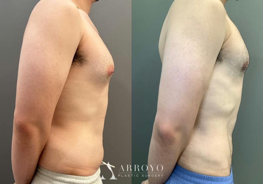 Gynecomastia Before & After Gallery - Patient 331523 - Image 3