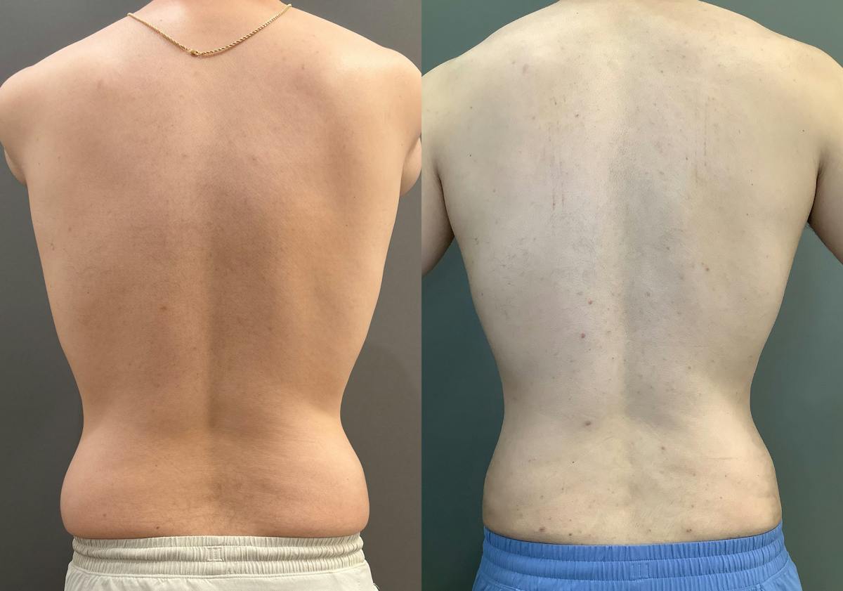 Gynecomastia Before & After Gallery - Patient 331523 - Image 4