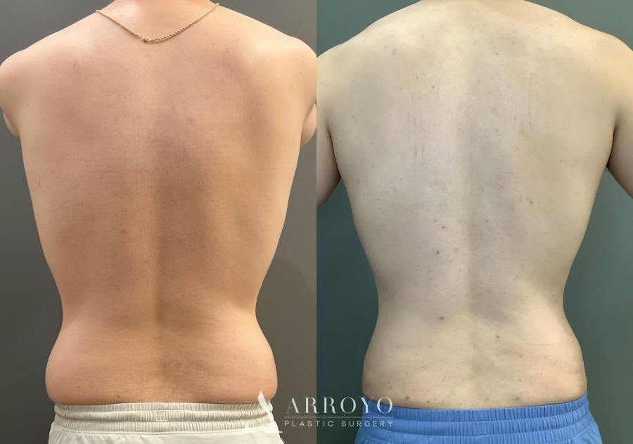 Gynecomastia Before & After Gallery - Patient 331523 - Image 4