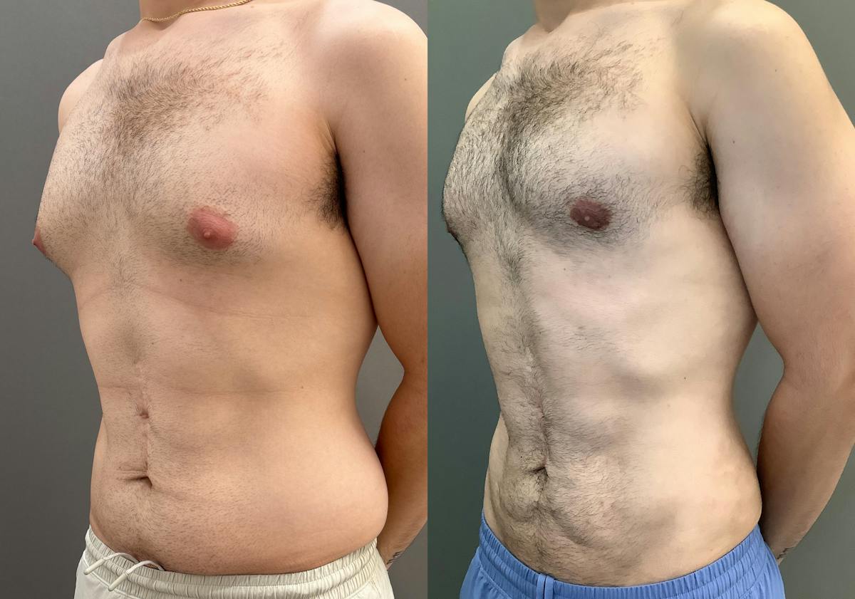 Gynecomastia Before & After Gallery - Patient 331523 - Image 5