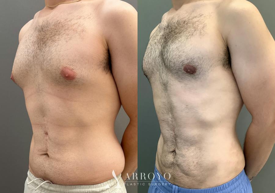 Gynecomastia Before & After Gallery - Patient 331523 - Image 5