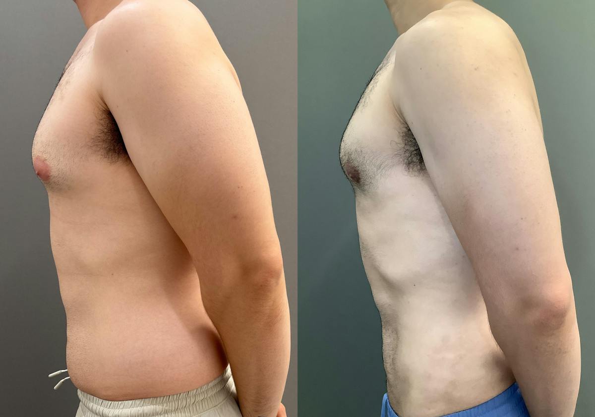 Gynecomastia Before & After Gallery - Patient 331523 - Image 6
