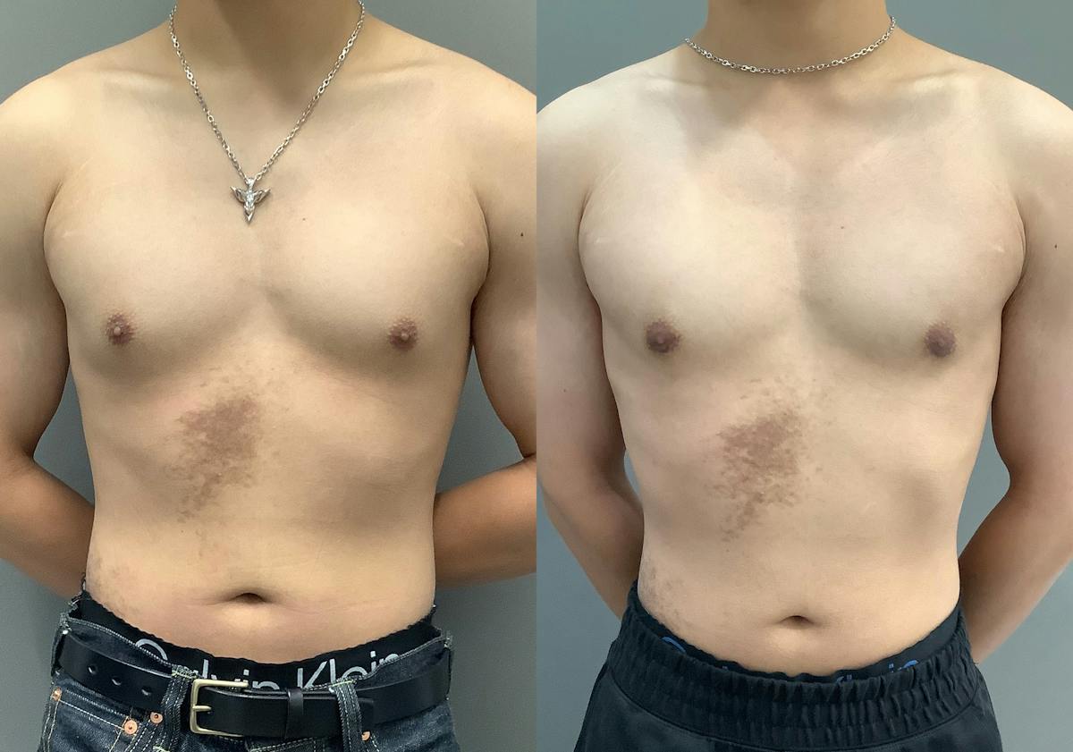 Gynecomastia Before & After Gallery - Patient 300053 - Image 1