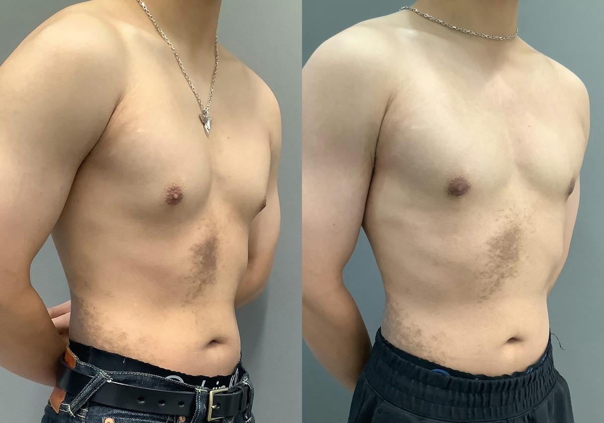 Gynecomastia Before & After Gallery - Patient 300053 - Image 2
