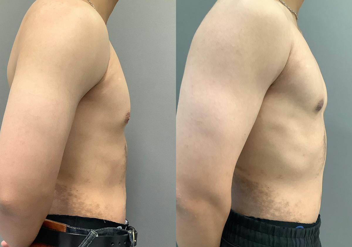Gynecomastia Before & After Gallery - Patient 300053 - Image 3