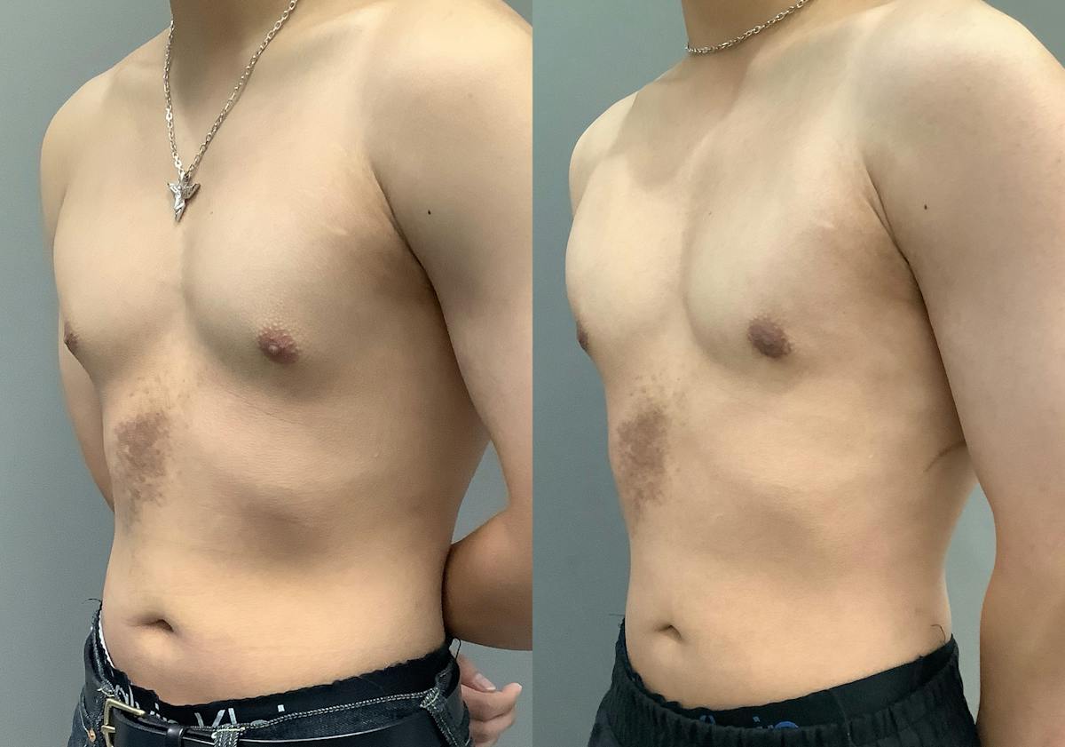 Gynecomastia Before & After Gallery - Patient 300053 - Image 4