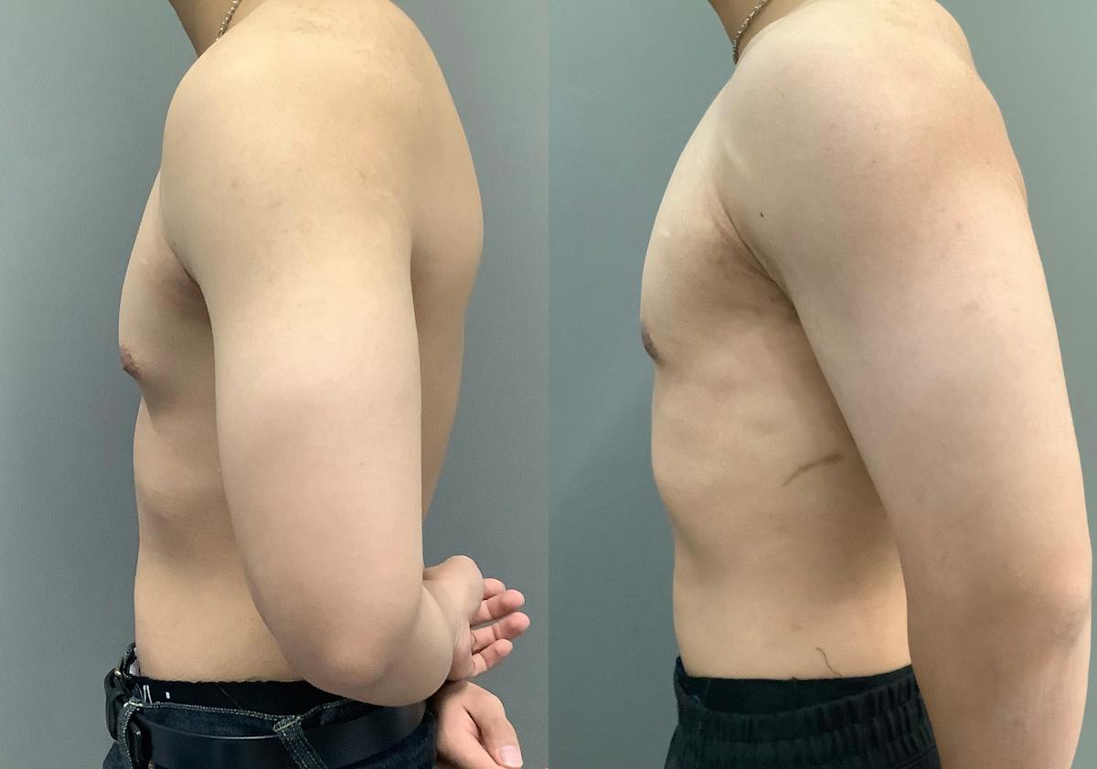Gynecomastia Before & After Gallery - Patient 300053 - Image 5