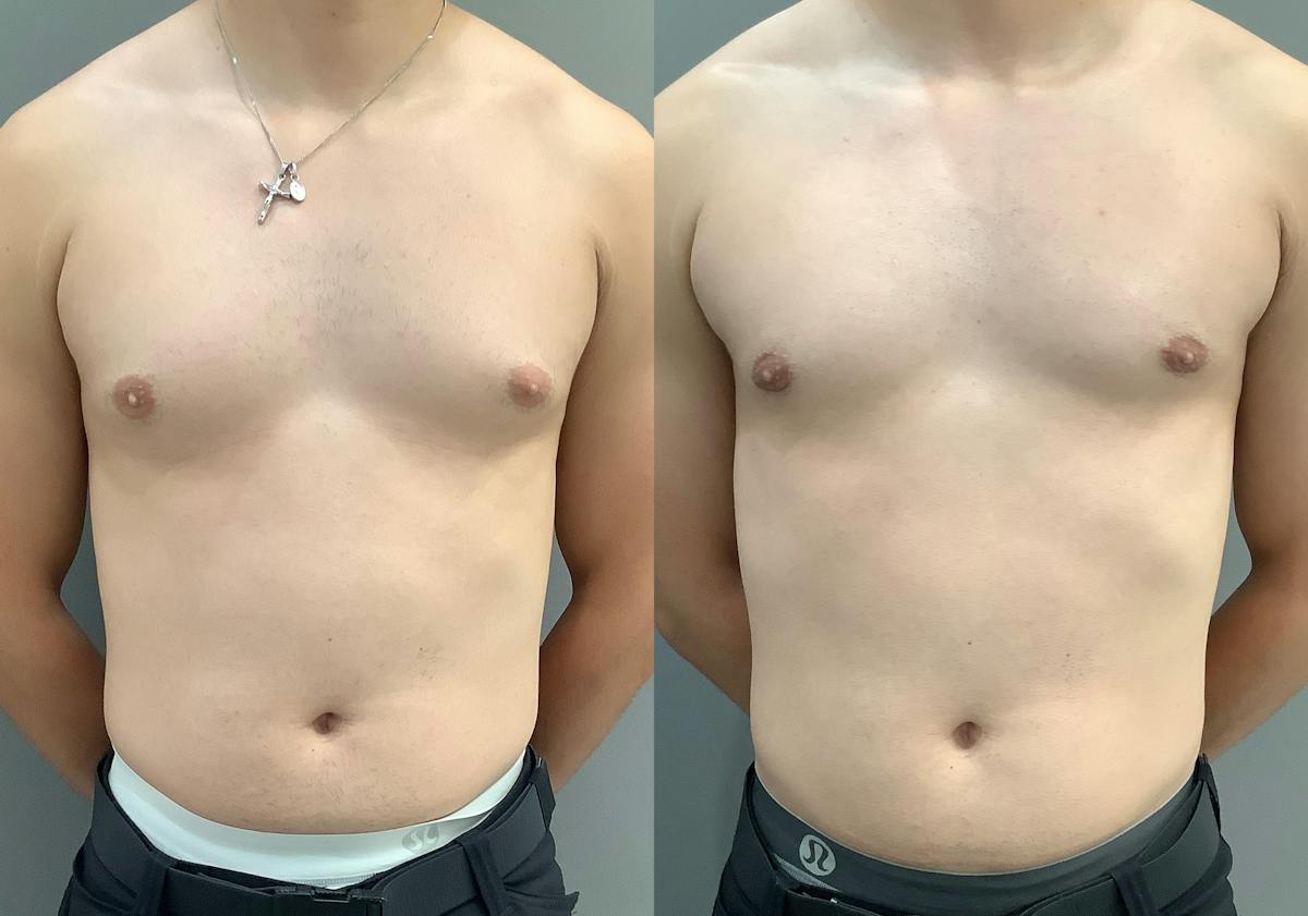 Gynecomastia Before & After Gallery - Patient 367117 - Image 1