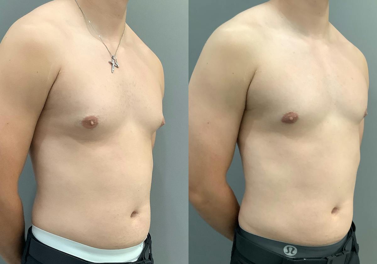 Gynecomastia Before & After Gallery - Patient 367117 - Image 2