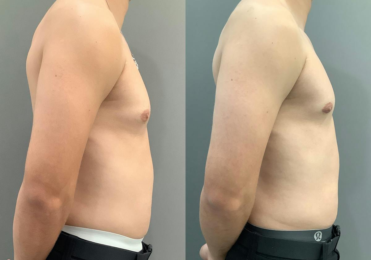 Gynecomastia Before & After Gallery - Patient 367117 - Image 3