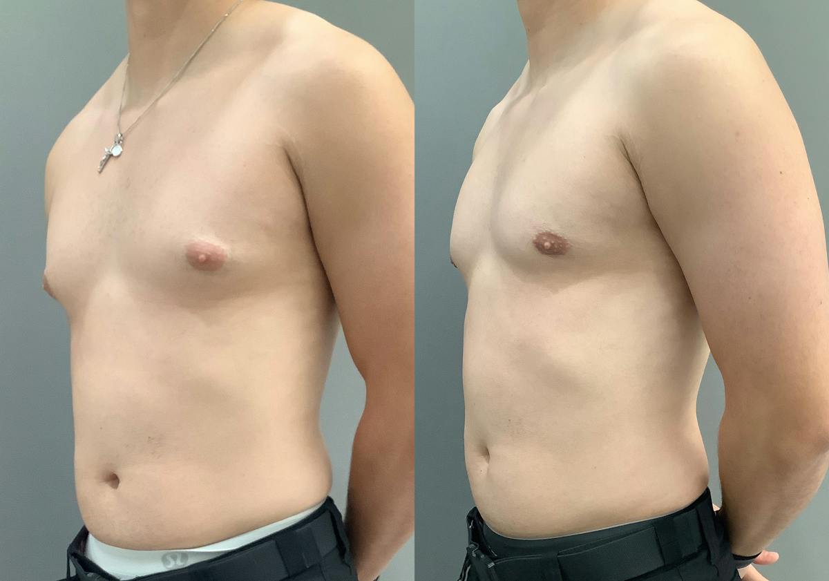 Gynecomastia Before & After Gallery - Patient 367117 - Image 4