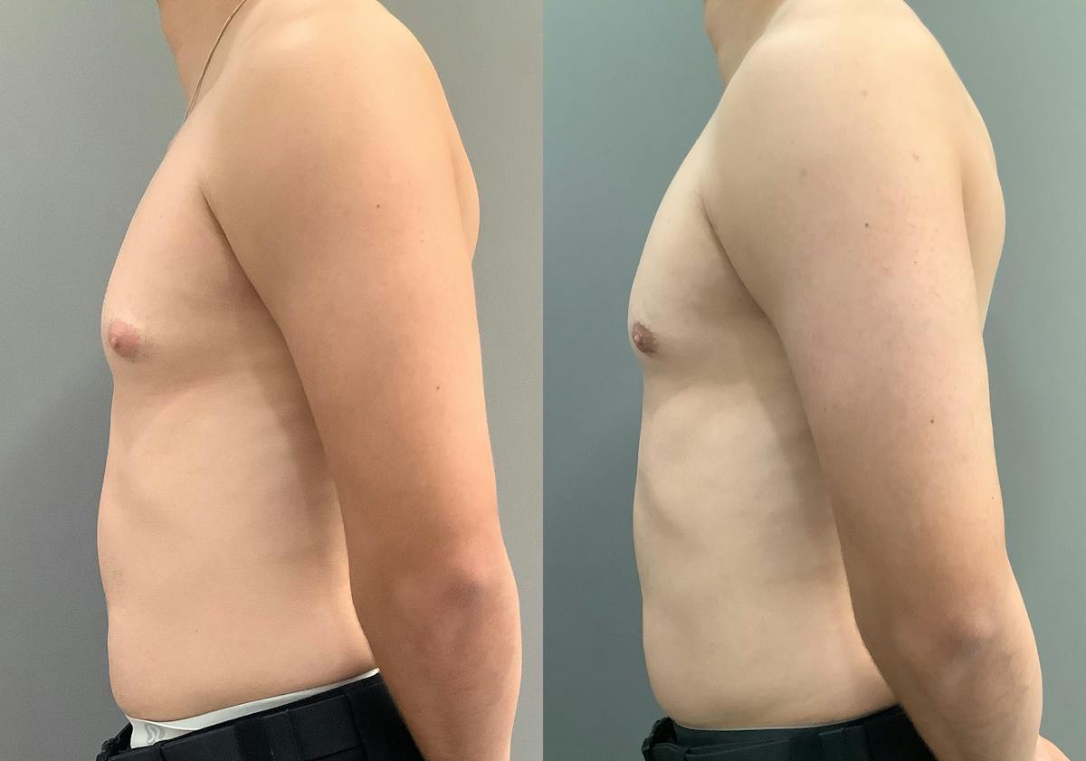 Gynecomastia Before & After Gallery - Patient 367117 - Image 5