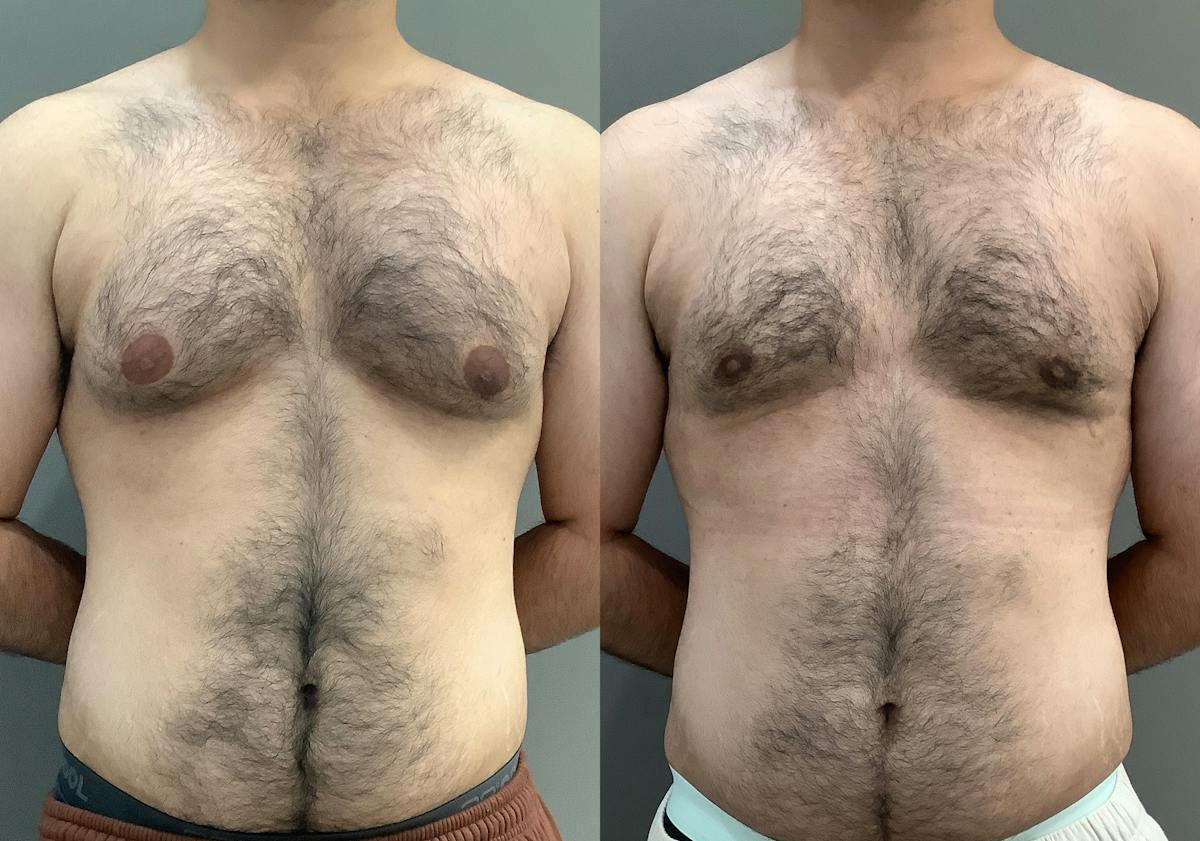Gynecomastia Before & After Gallery - Patient 422058 - Image 1