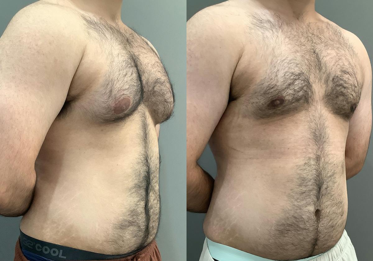Gynecomastia Before & After Gallery - Patient 422058 - Image 2