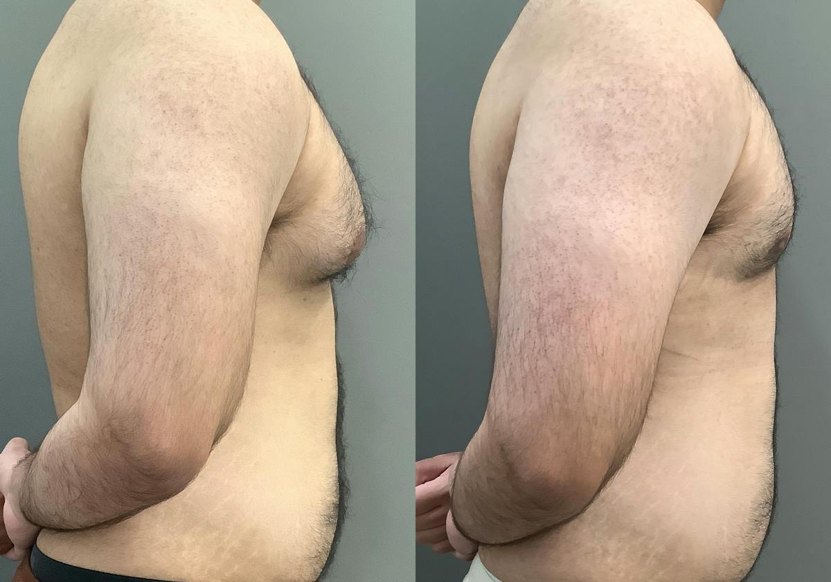 Gynecomastia Before & After Gallery - Patient 422058 - Image 3