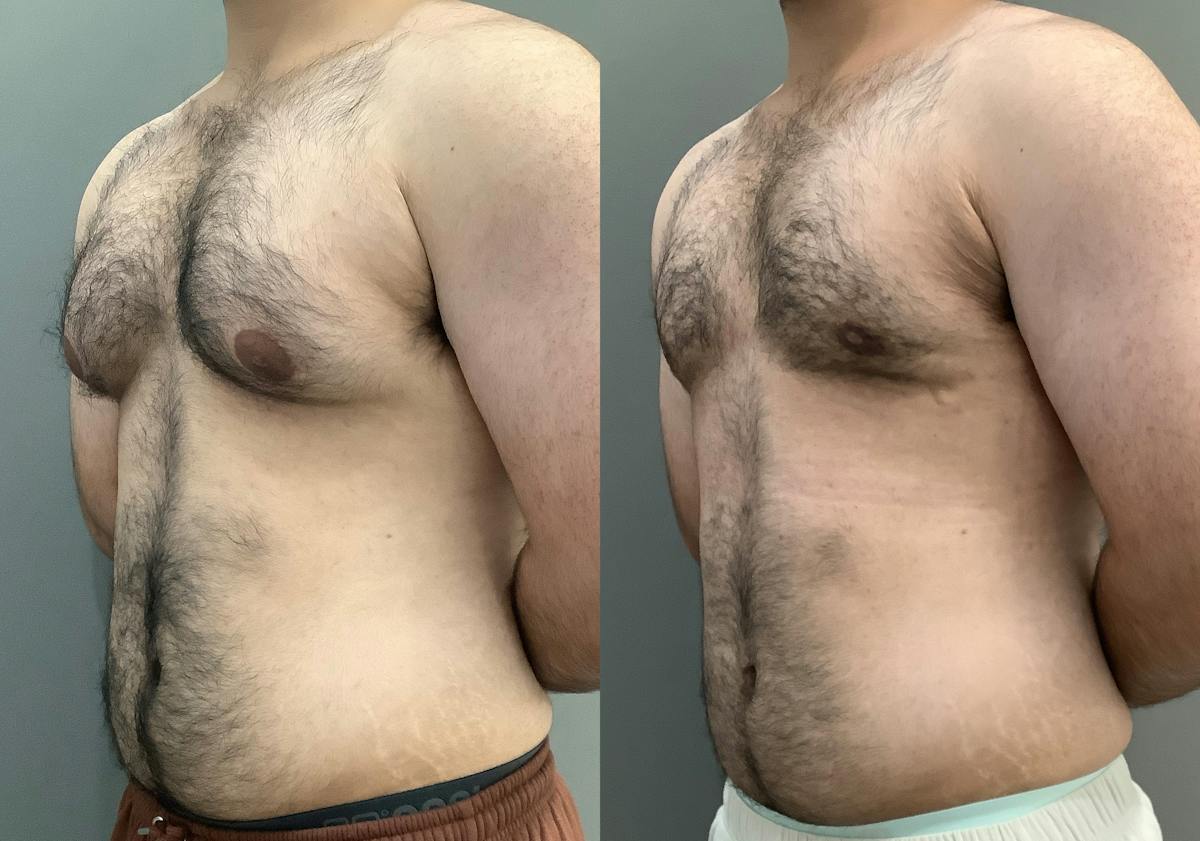 Gynecomastia Before & After Gallery - Patient 422058 - Image 4
