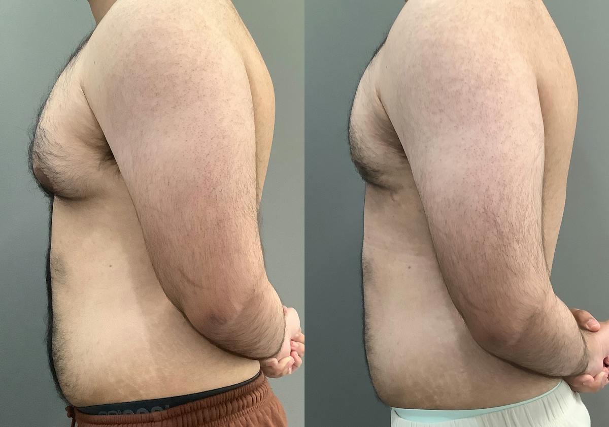 Gynecomastia Before & After Gallery - Patient 422058 - Image 5