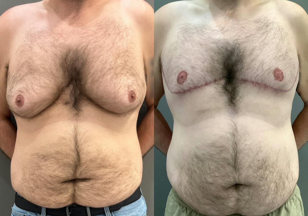 Gynecomastia Before & After Gallery - Patient 307557 - Image 1