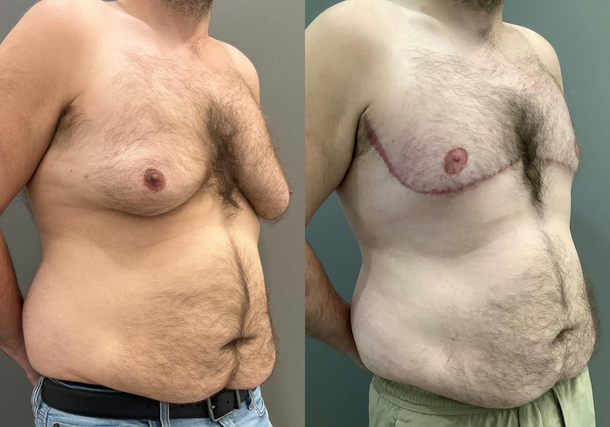Gynecomastia Before & After Gallery - Patient 307557 - Image 2
