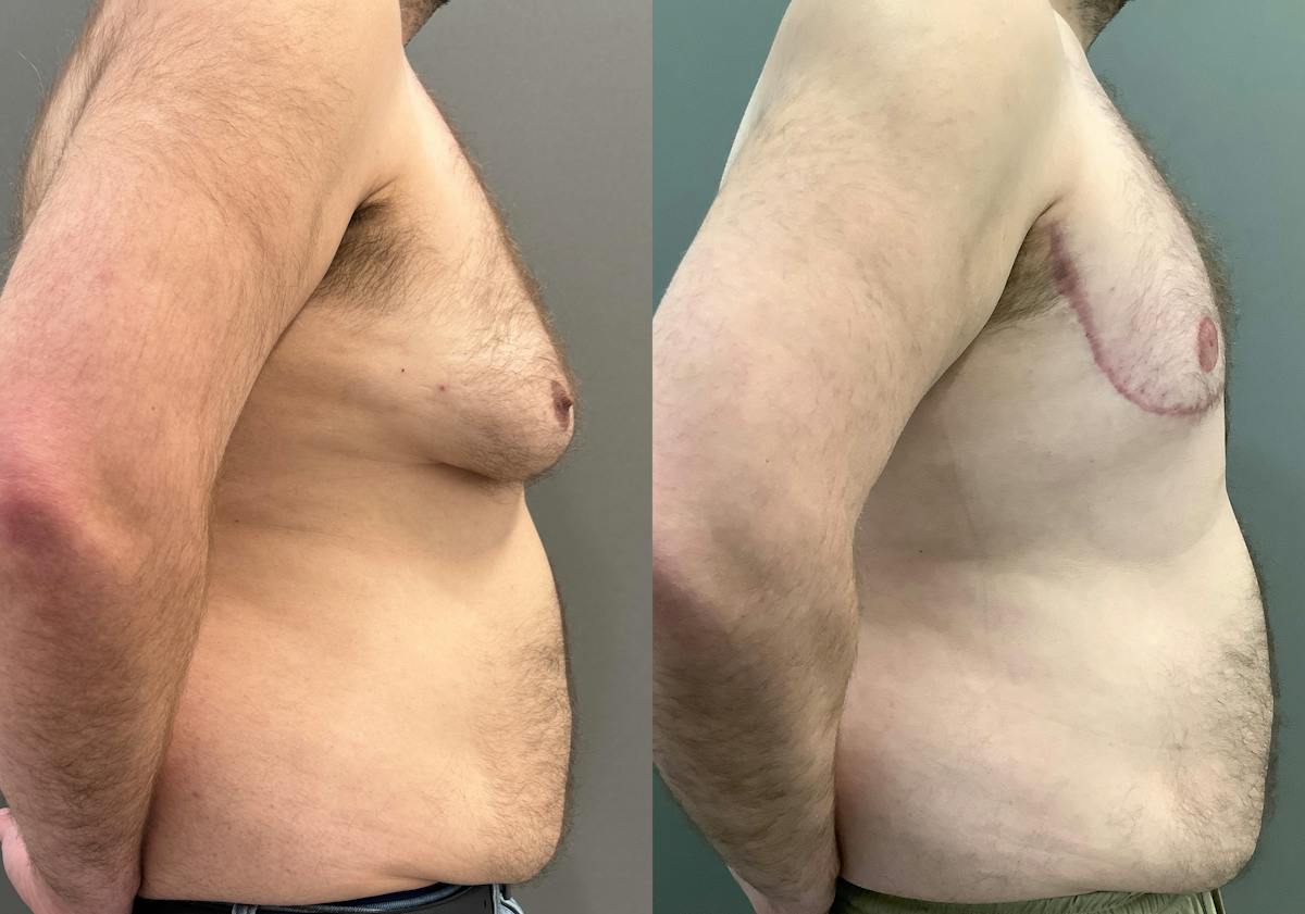 Gynecomastia Before & After Gallery - Patient 307557 - Image 3