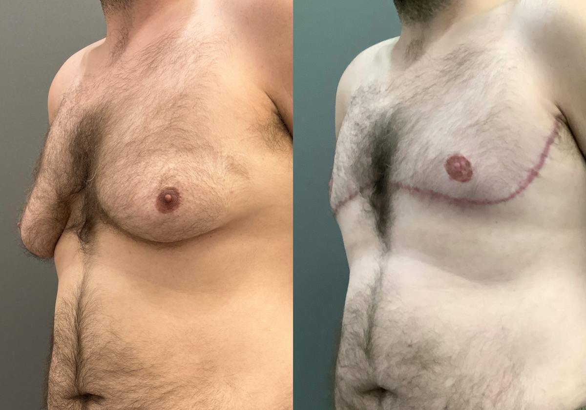 Gynecomastia Before & After Gallery - Patient 307557 - Image 4