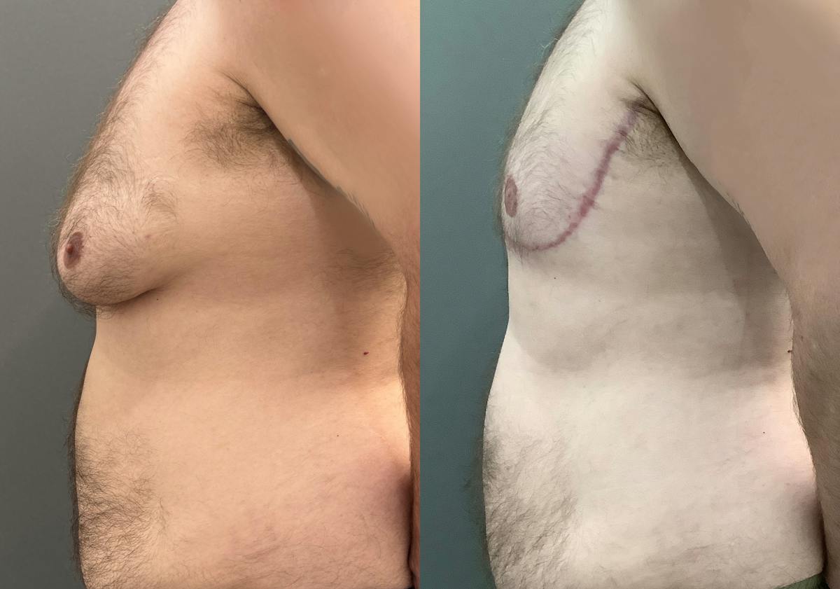 Gynecomastia Before & After Gallery - Patient 307557 - Image 5