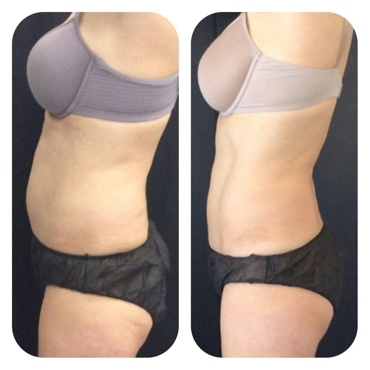 Before & After Coolsculpting