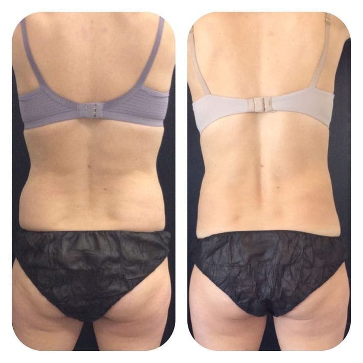 Before & After Coolsculpting