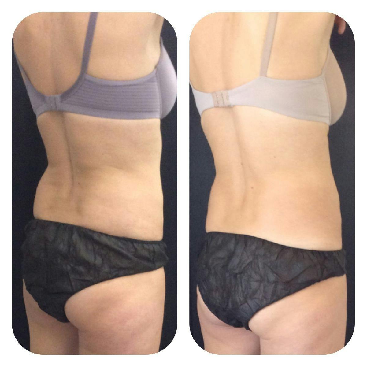 Before & After Coolsculpting