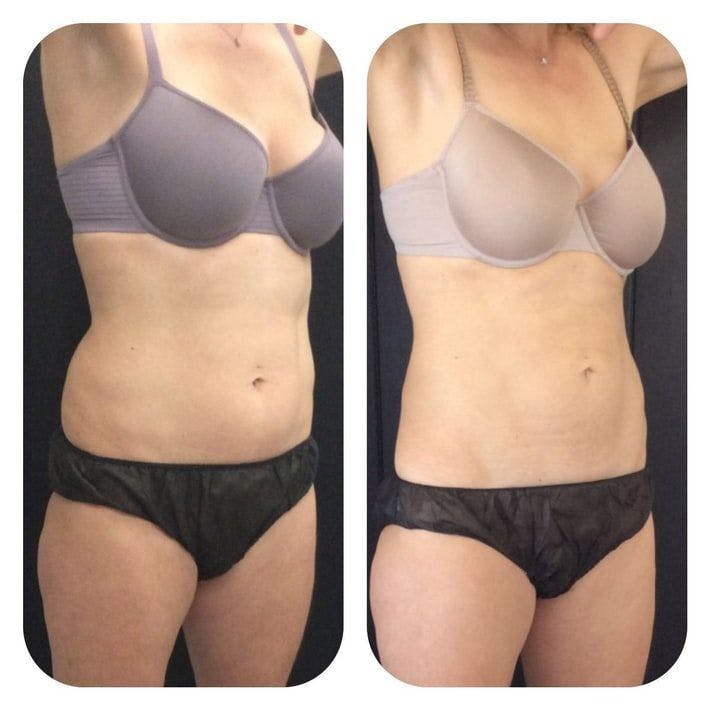 Before & After Coolsculpting