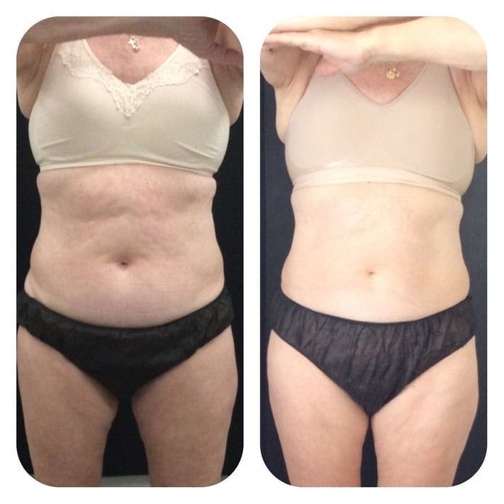 Before & After Coolsculpting