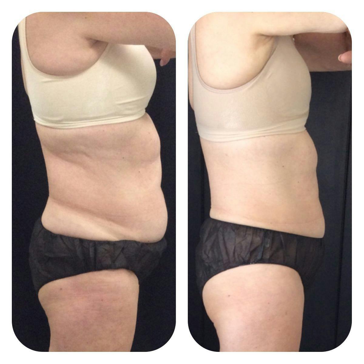 Before & After Coolsculpting