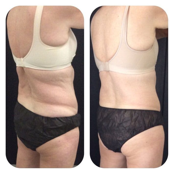 Before & After Coolsculpting
