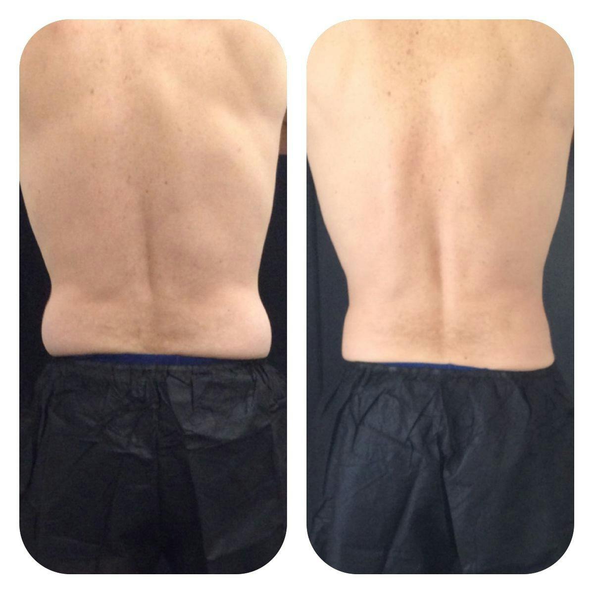 Before & After Coolsculpting