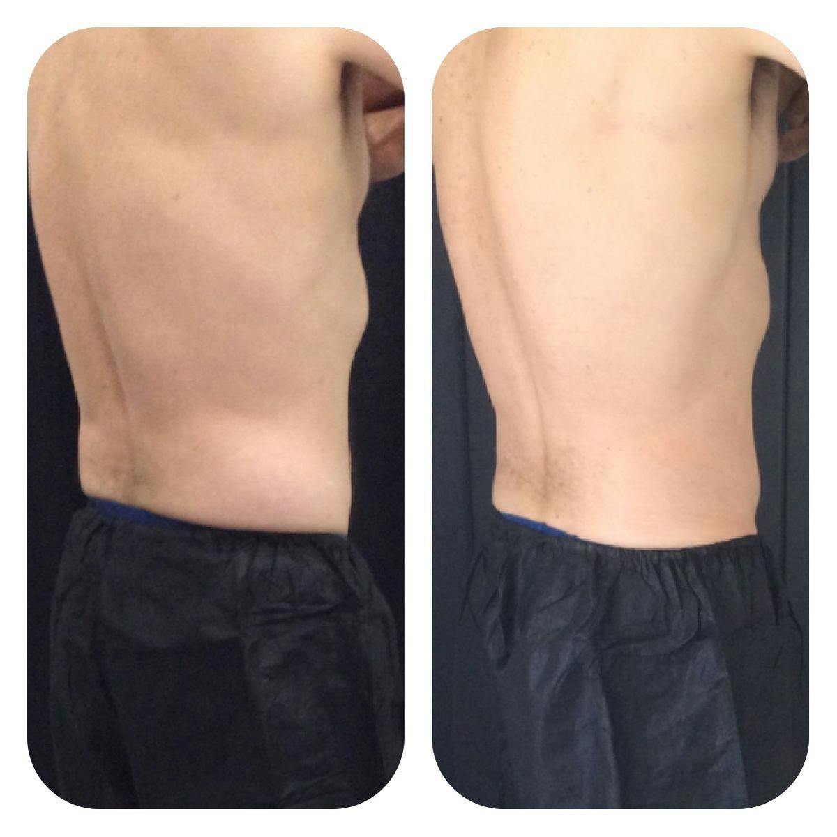 Before & After Coolsculpting