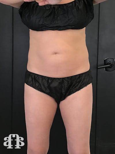 CoolSculpting Before & After Gallery - Patient 52660116 - Image 1