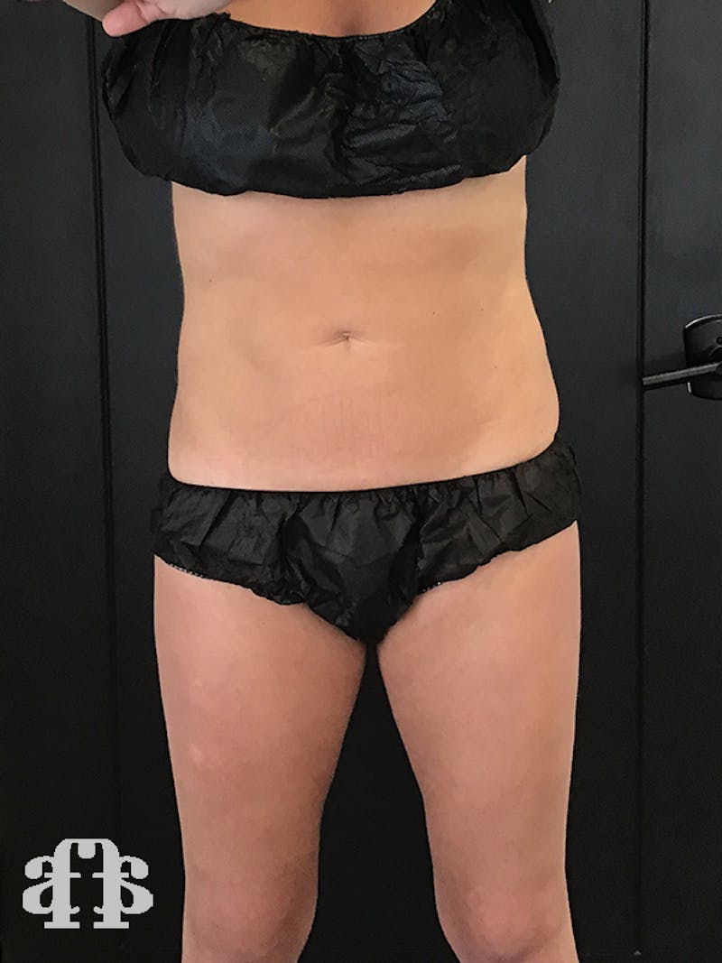 CoolSculpting Before & After Gallery - Patient 52660116 - Image 2