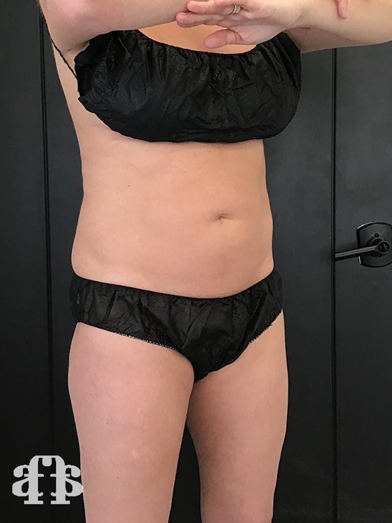 CoolSculpting Before & After Gallery - Patient 52660116 - Image 3