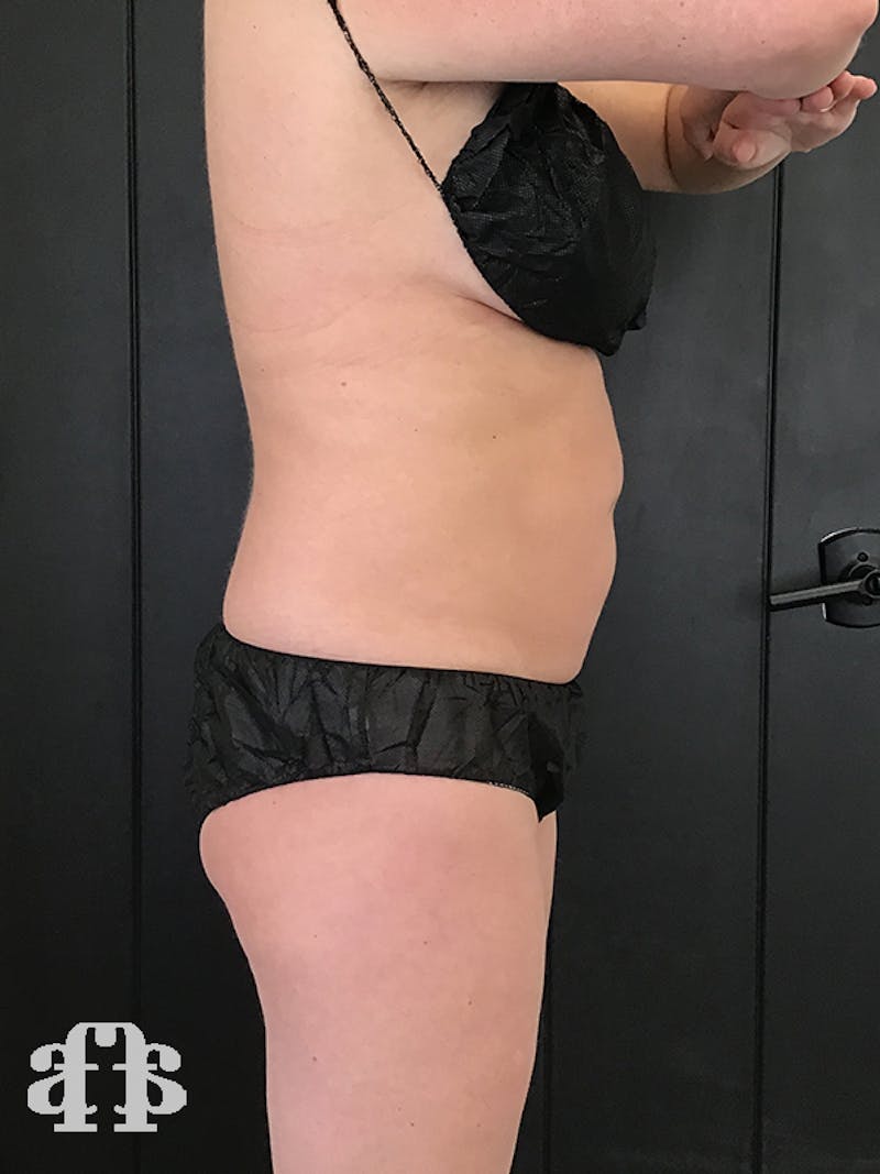 CoolSculpting Before & After Gallery - Patient 52660116 - Image 5
