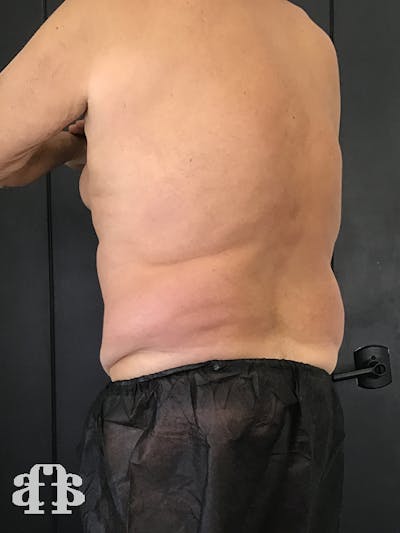 CoolSculpting Gallery - Patient 52660119 - Image 1