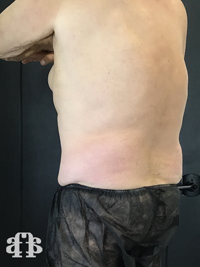 CoolSculpting Before & After Gallery - Patient 52660119 - Image 2