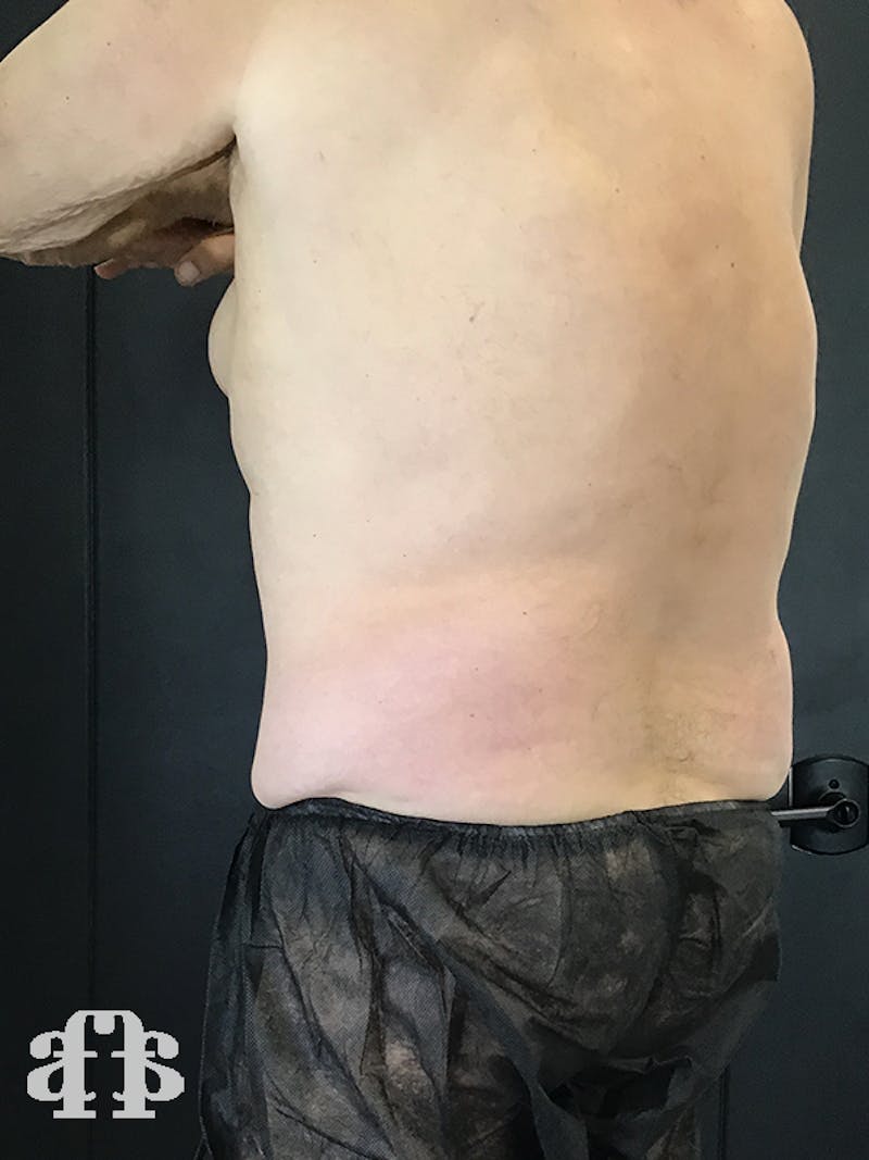 CoolSculpting Before & After Gallery - Patient 52660119 - Image 2