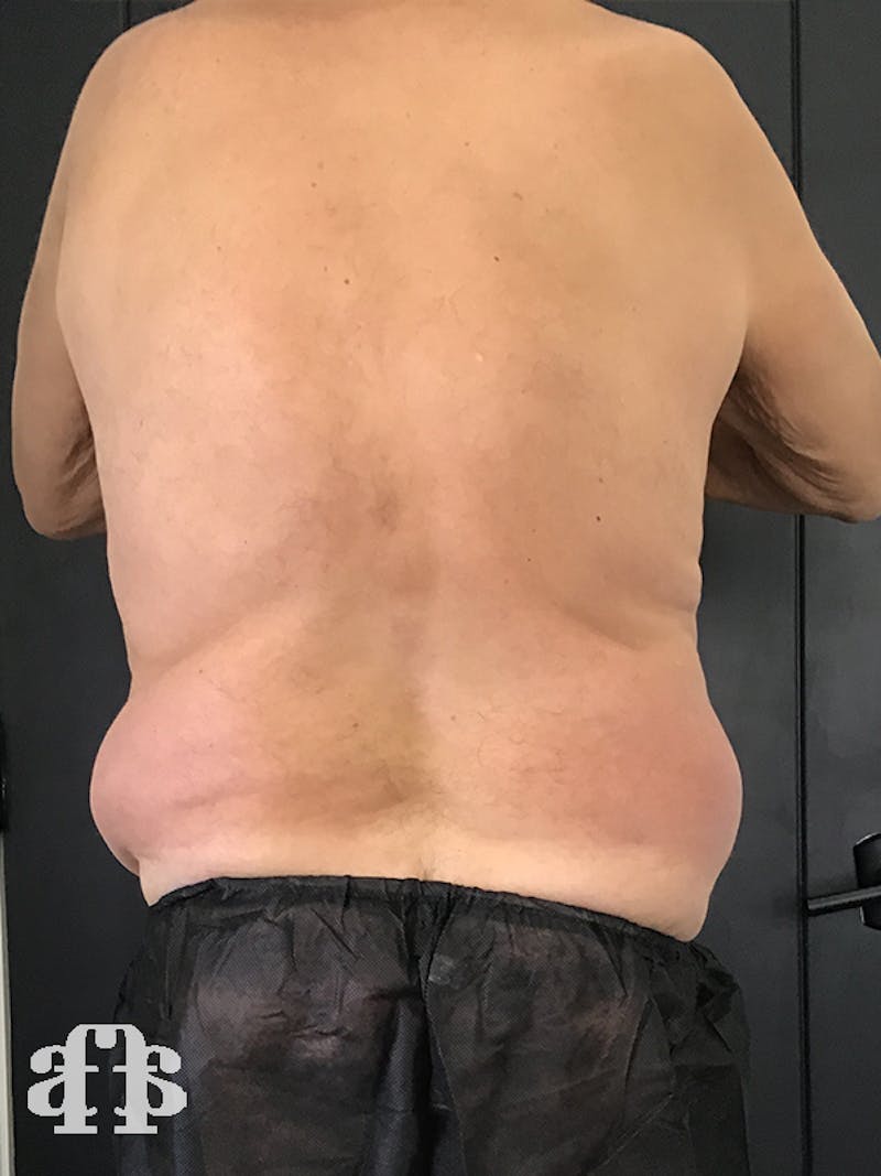 CoolSculpting Before & After Gallery - Patient 52660119 - Image 3