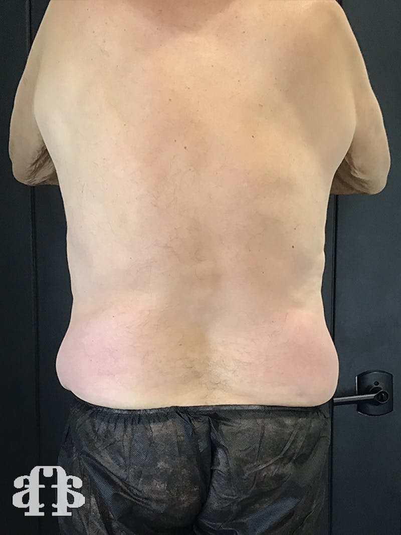 CoolSculpting Before & After Gallery - Patient 52660119 - Image 4